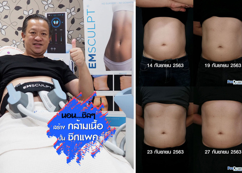 EMsculpt นอนชิลๆ สร้างกล้ามเนื้อ ปั้นซิกแพค