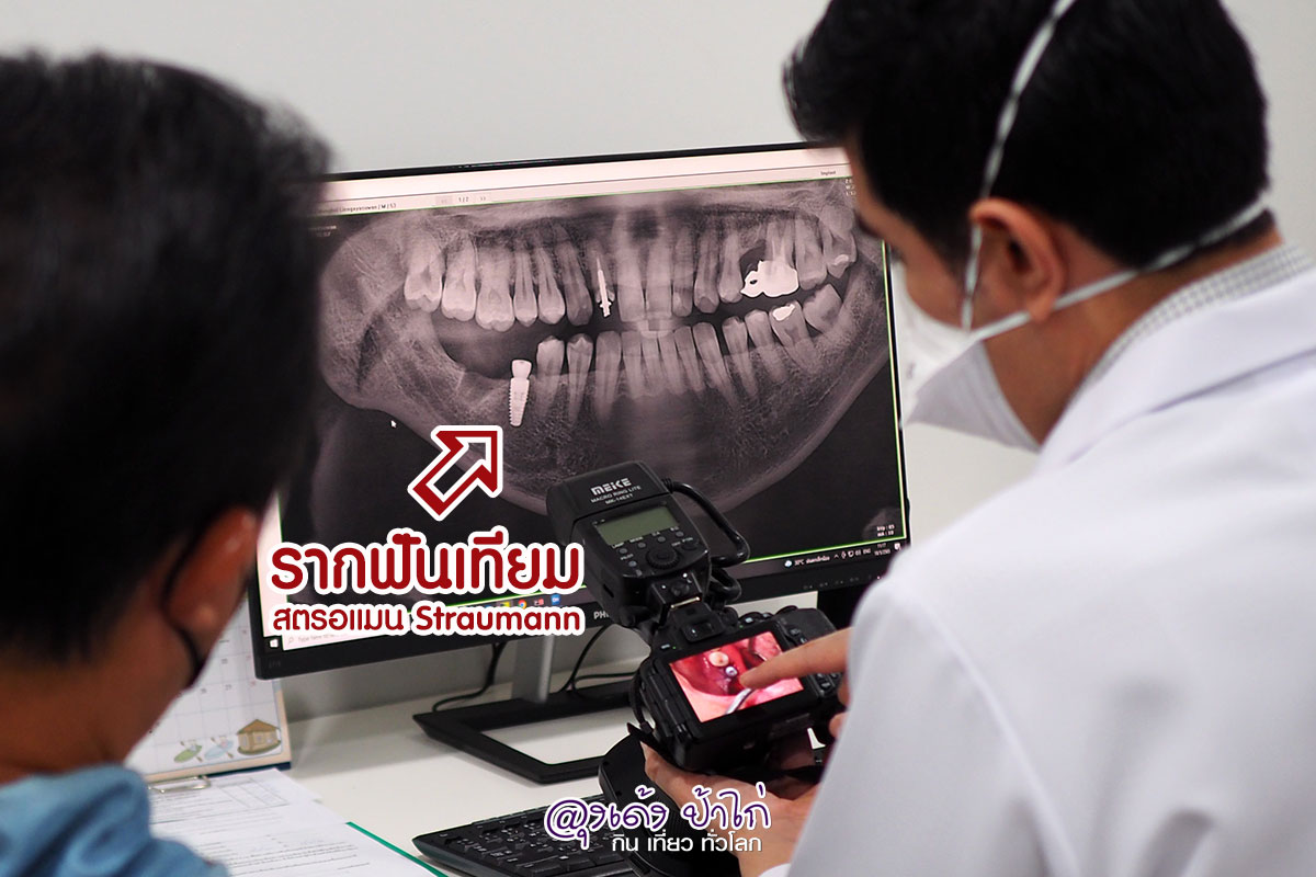 รีวิว ทำรากฟันเทียม หมอ บอน VP Dental Clinic รีวิว by ลุงเด้ง ป้าไก่