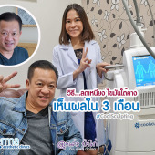 CoolSculpting รีวิว ลดเหนียง ลดไขมันใต้คาง โพรเดอร์มา