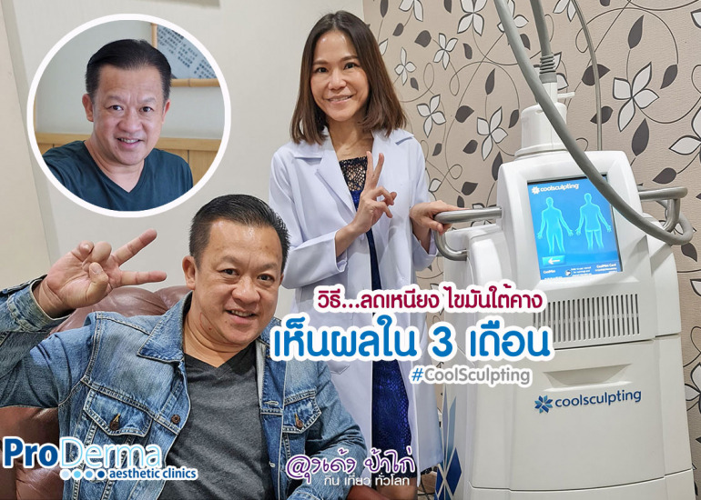 CoolSculpting รีวิว ลดเหนียง ลดไขมันใต้คาง โพรเดอร์มา