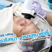 InMode Lifting รีวิว ยกกระชับ กรอบหน้าชัดขึ้น : Proderma