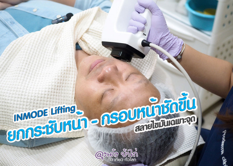 InMode Lifting รีวิว ยกกระชับ กรอบหน้าชัดขึ้น : Proderma